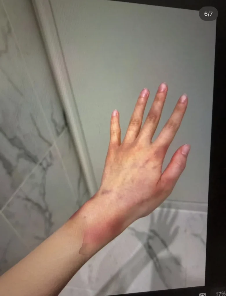 Physical injury photos from domestic abuse allegations against Jisoo’s brother