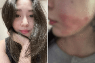 What Happened to Mina? Cosmetic Procedure Leaves Burns, Scars