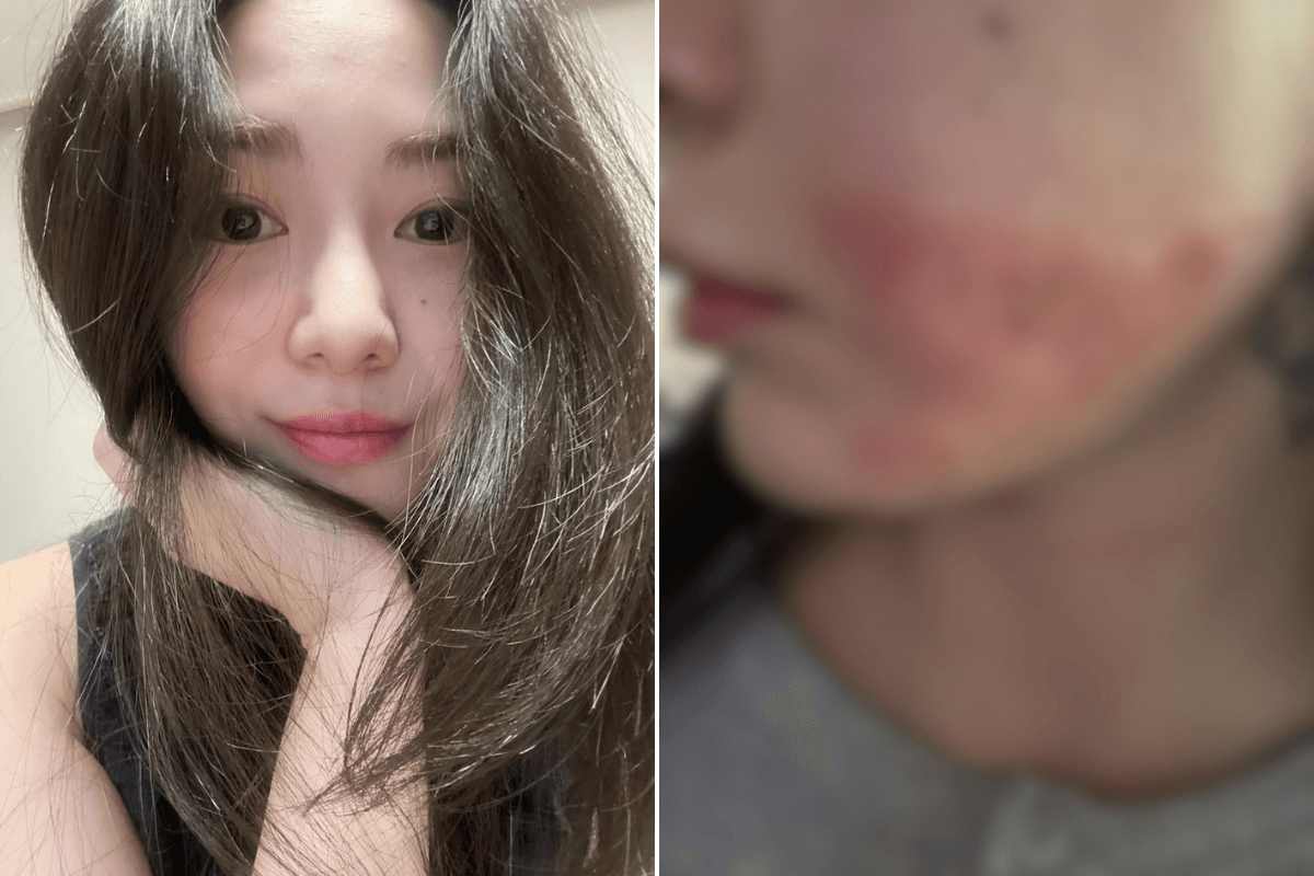 Read more about the article What Happened to Mina? Cosmetic Procedure Leaves Burns, Scars